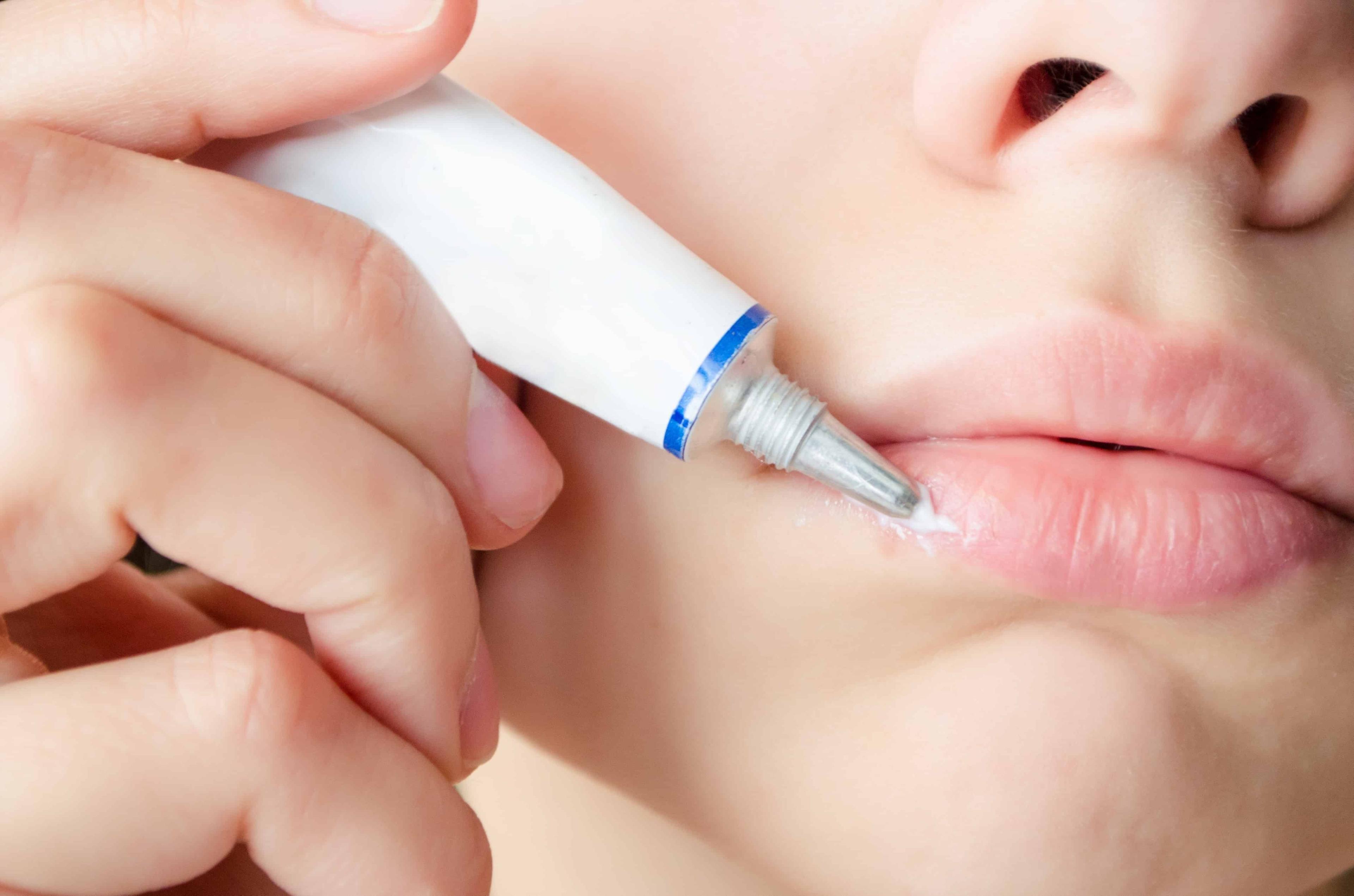 get-rid-of-pimples-on-your-lip-naturally