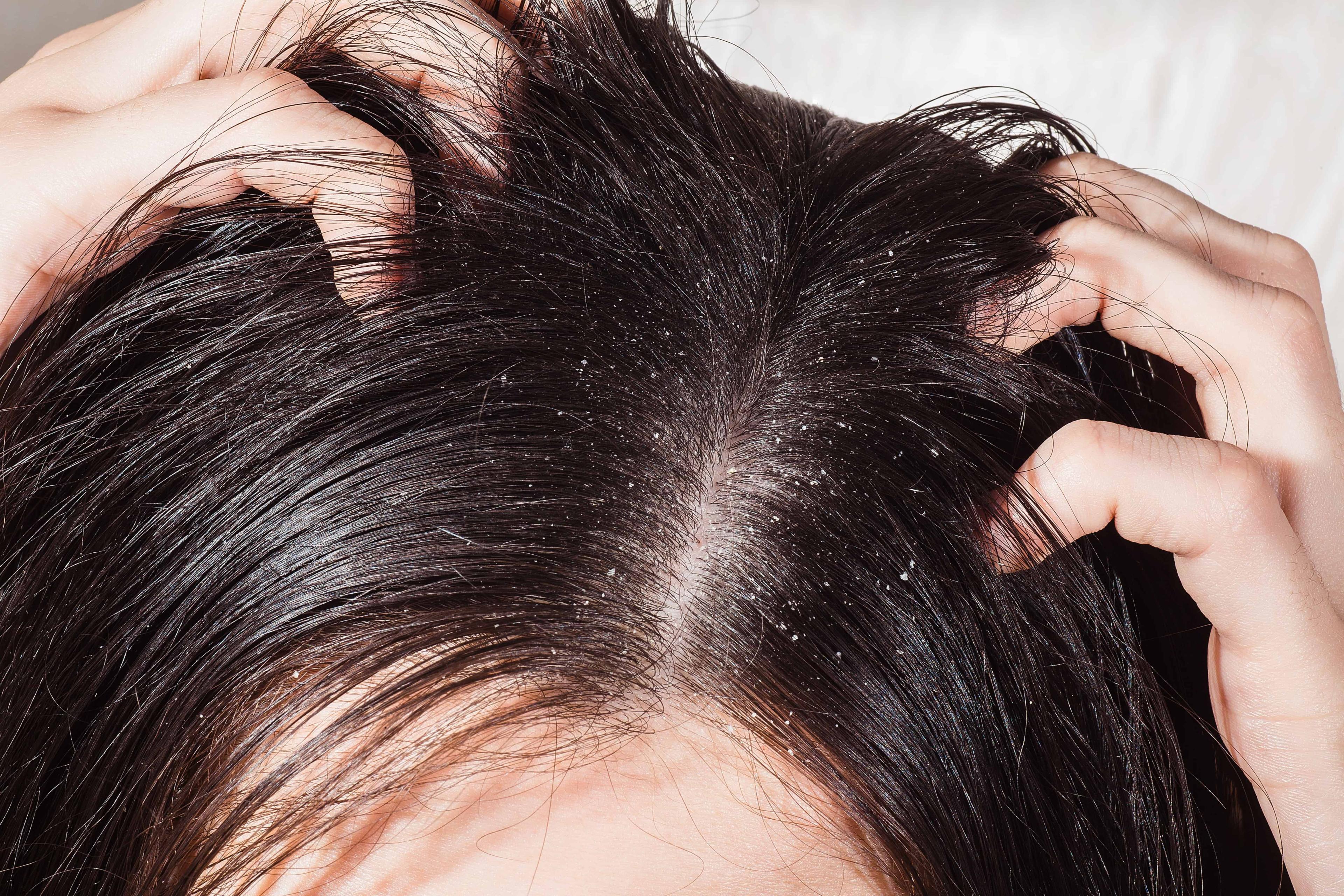 can-dandruff-cause-hair-loss