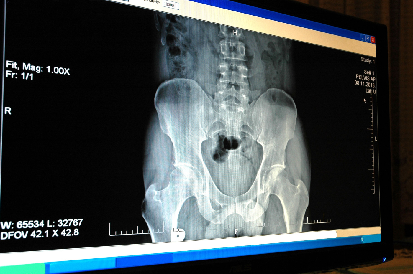 Osteoporosis (အရိုးပွရောဂါ)