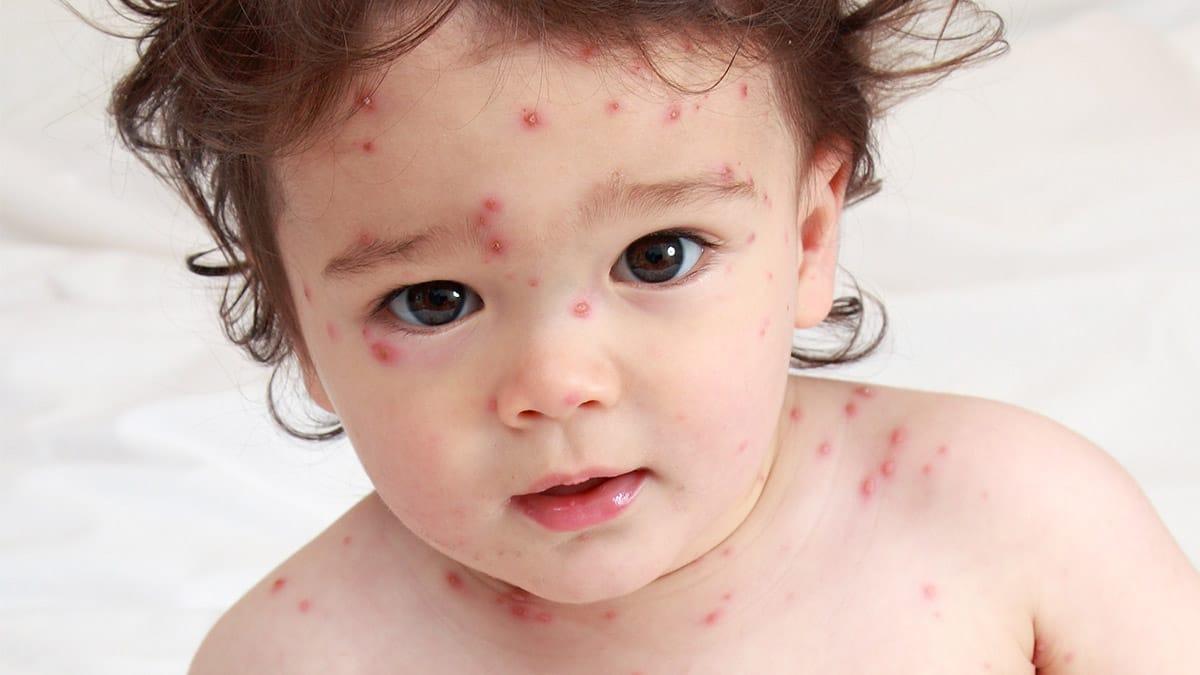 chickenpox-%e1%80%9b%e1%80%b1%e1%80%80%e1%80%bb%e1%80%b1%e1%80%ac%e1%80%80%e1%80%ba-%e1%80%9b%e1%80%b1%e1%80%ac%e1%80%82%e1%80%ab