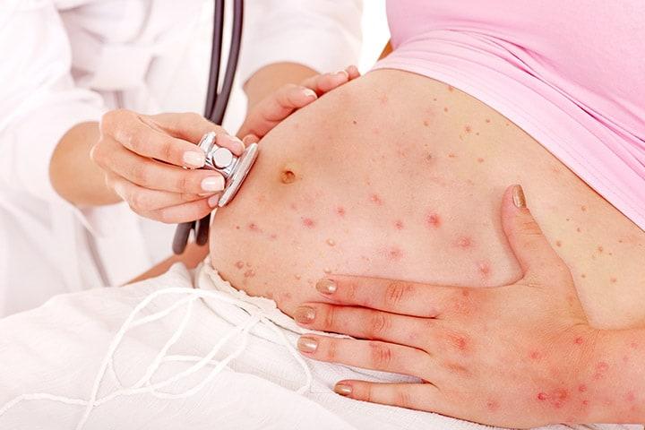 chicken-pox-and-pregnancy