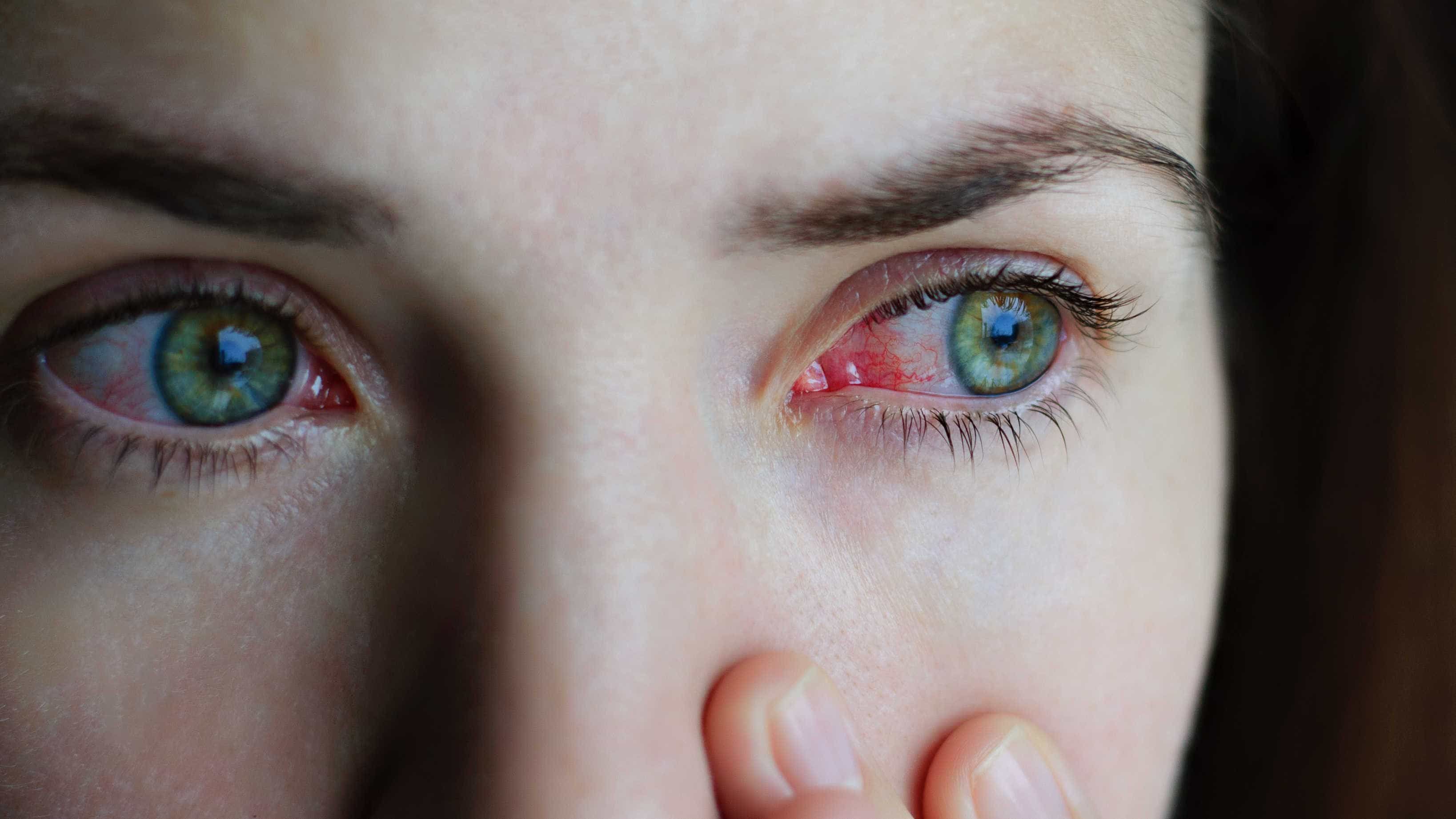 what-you-need-to-know-about-conjunctivitis