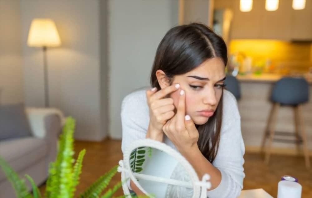 acne-and-black-heads-home-remedies