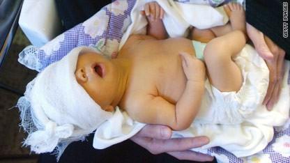 Jaundice (အသားဝါခြင်း)