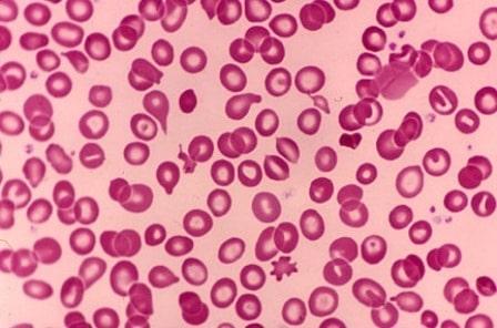 သယ်လ်ဆီးမီးယား (thalassemia) ရောဂါ အကြောင်းသိကောင်းစရာ