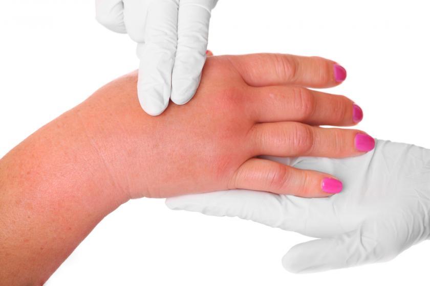 angioedema-%e1%80%93%e1%80%ab%e1%80%90%e1%80%ba%e1%80%99%e1%80%90%e1%80%8a%e1%80%b7%e1%80%ba%e1%80%99%e1%80%be%e1%80%af%e1%80%80%e1%80%bc%e1%80%b1%e1%80%ac%e1%80%84%e1%80%b7%e1%80%ba-%e1%80%a1