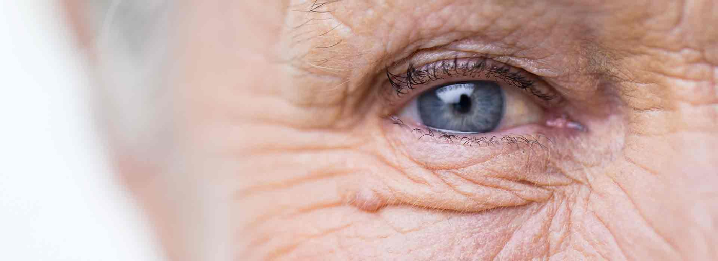 Glaucoma (မျက်စိ ရေတိမ်)