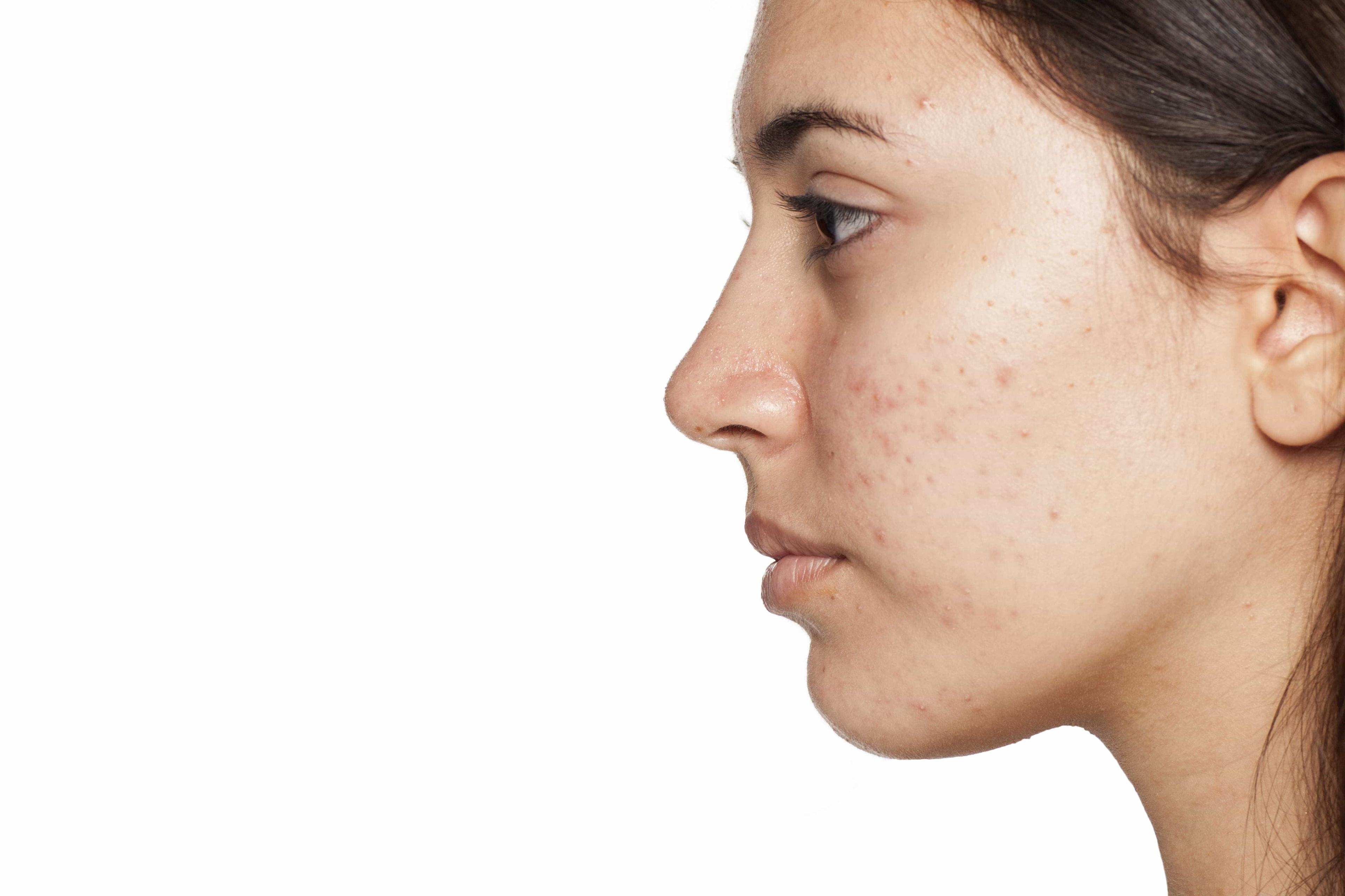 acne-scar-removal-for-teens