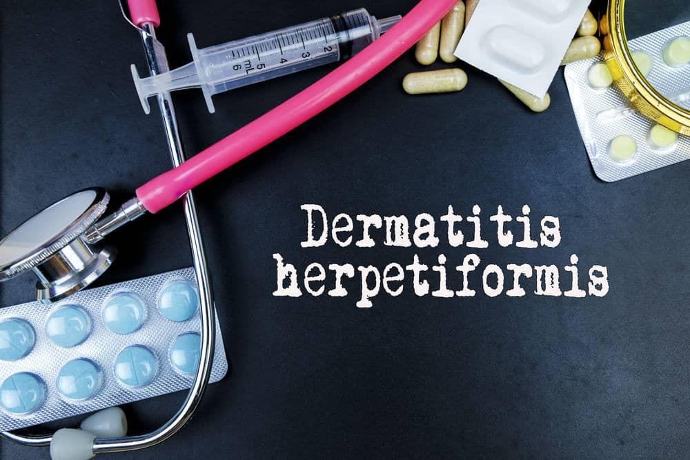 Dermatitis herpetiformis(DH) áááŻáˇááąáŤáşáá˛áˇ ááŹá¸ááśáááşáá˛áˇáĄááŽááąáŹááşáĄáááşááźááşááŻááąá¸áá˝áąááąáŤááşááźááşá¸