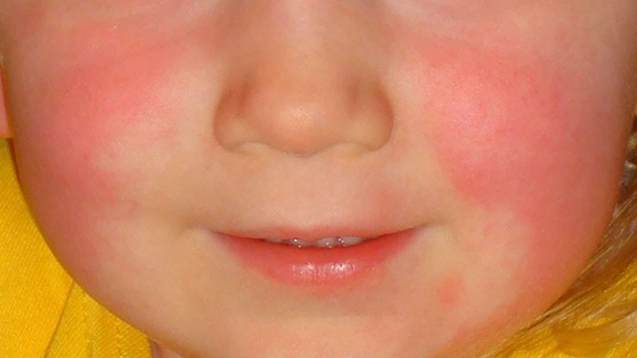fifth disease ဆိုတာဘာလဲ