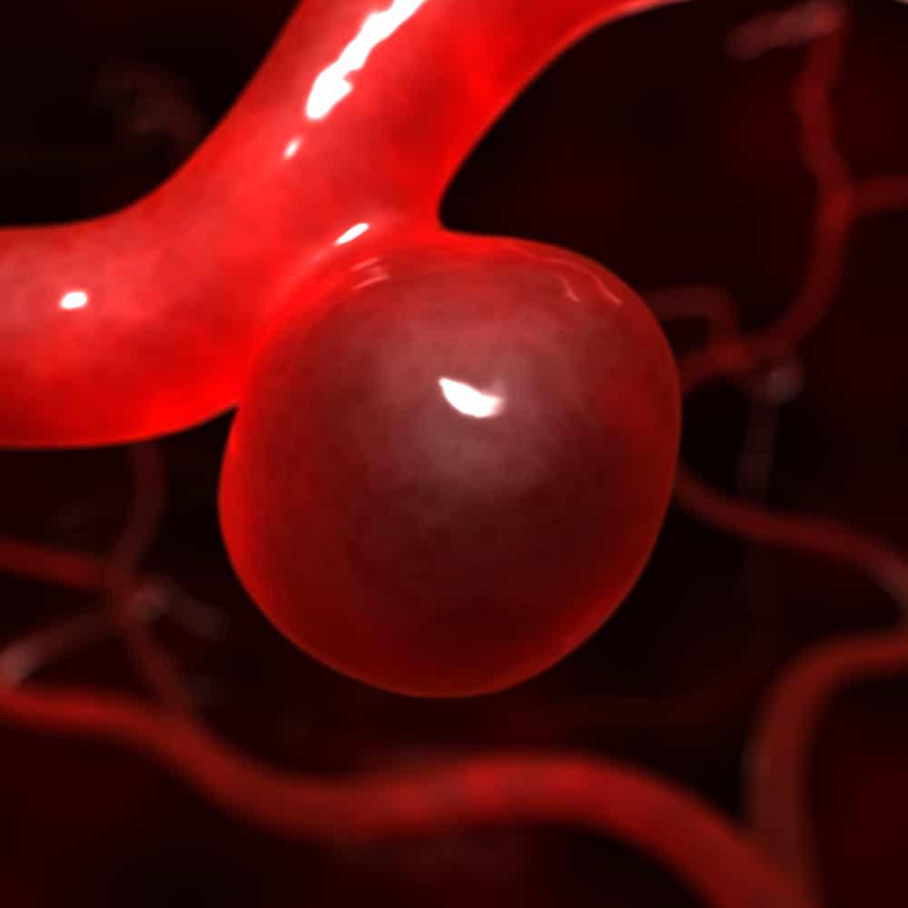 Cerebral Aneurysm (ဦးနှောက်အတွင်းရှိသွေးကြော ဖောင်းလာခြင်း။)