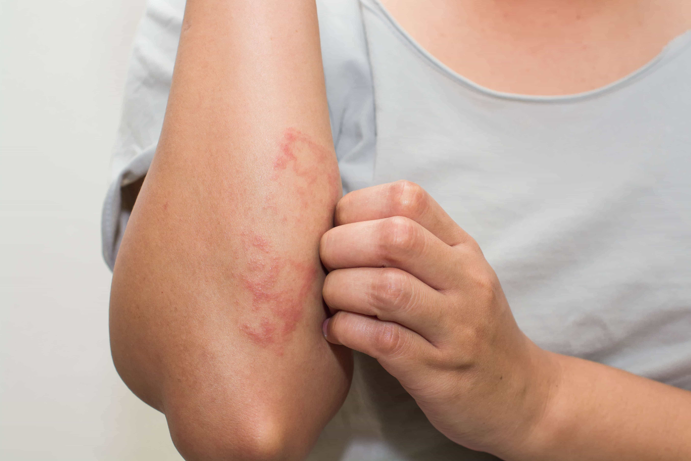 Atopic Dermatitis (နှင်းခူရောဂါ)