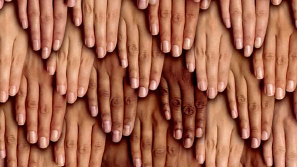 Skin Cancer (အရေပြားကင်ဆာ)