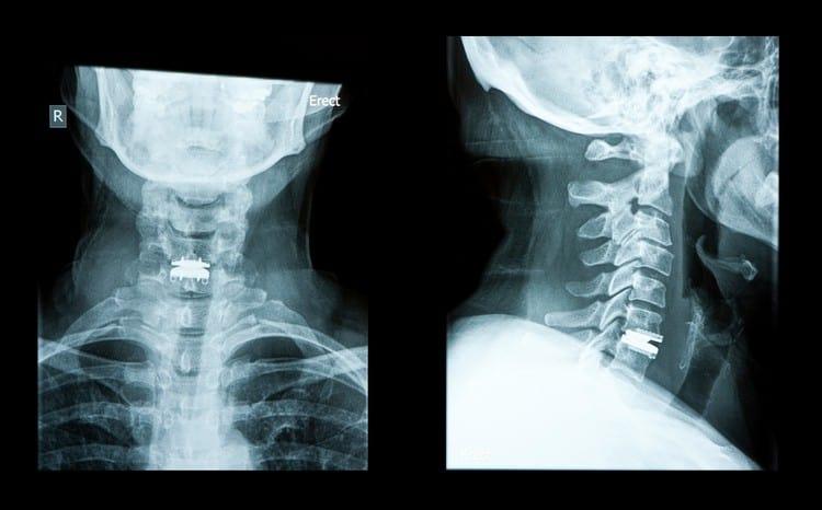 လည်းပင်းရိုးရောဂါ စစ်ဆေးကုသခြင်း