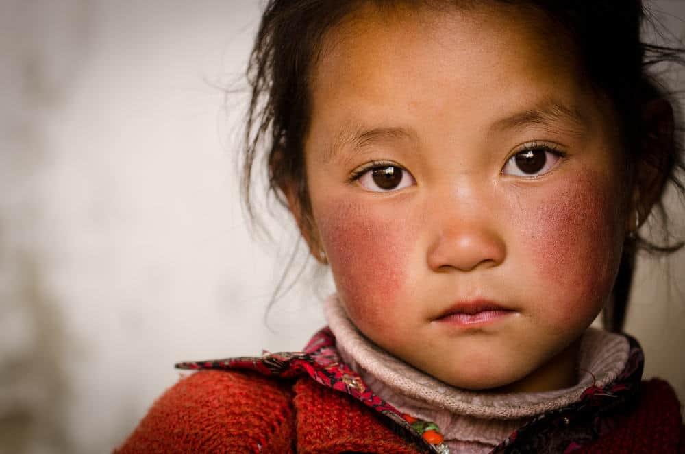 မြန်မာနိုင်ငံက ကလေးတွေမှာ အဖြစ်များတဲ့ အရေပြားပြဿနာတွေ