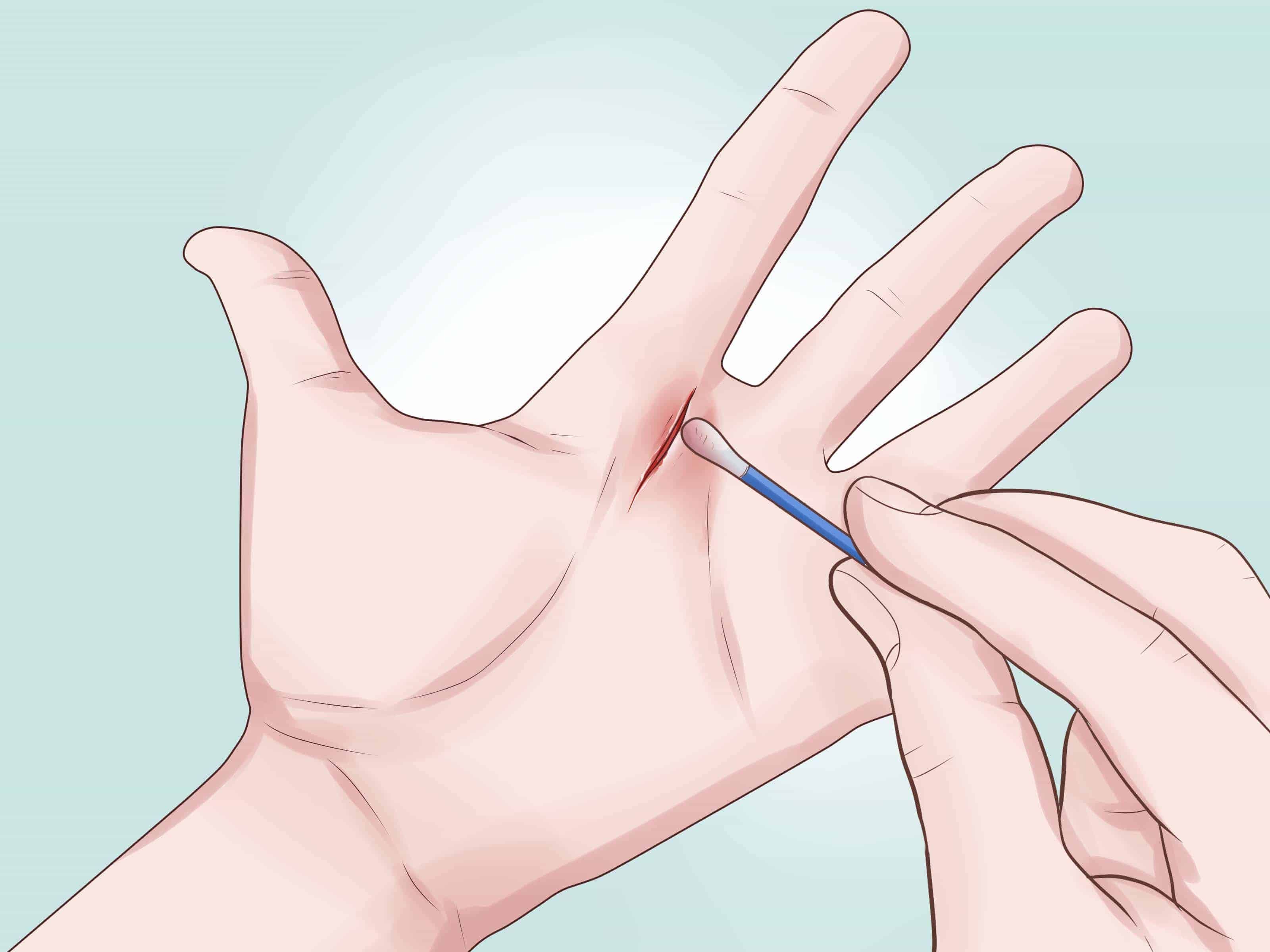 အနာကို သန့်စင်ဖို့ Hydrogen Peroxide သို့မဟုတ် အရက်ပြန်ကိုသုံးသင့်သလား