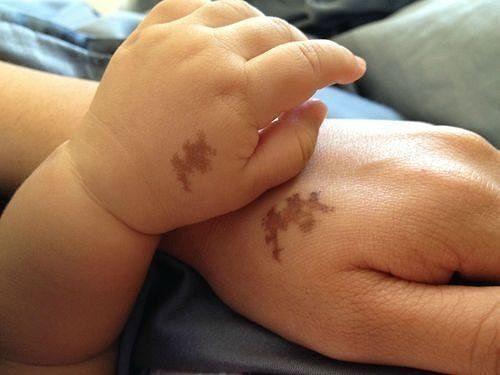 skin-conditions-and-birthmarks-in-newborns