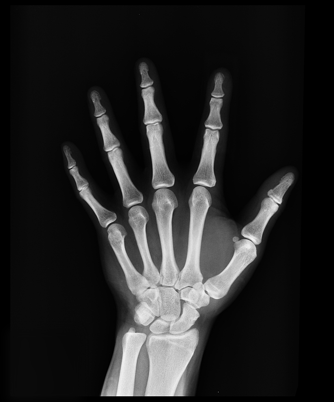 Bone Spurs (áĄáááŻá¸ááťáŹá¸ááąáŤáá˝ááşááźááşá¸)
