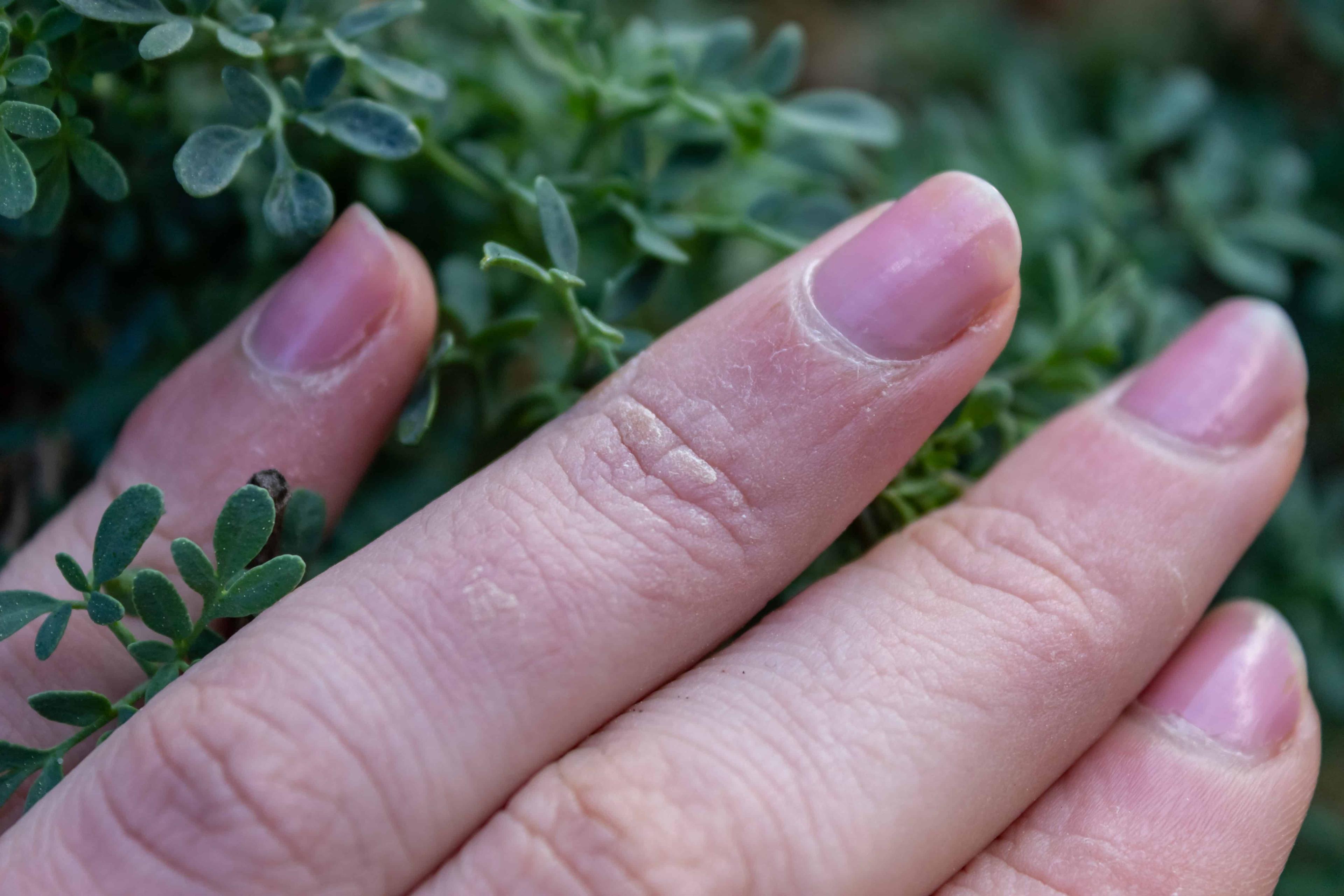 prevent-and-soothe-chapped-winter-hands