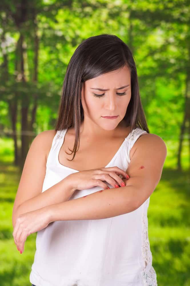 home-remedies-for-mosquito-bites