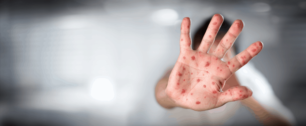 ဝက်သက်နဲ့ပတ်သက်ပြီး မှားတတ်တဲ့အတွေးများ