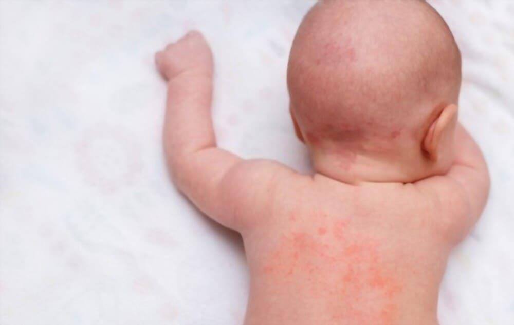home-remedies-to-get-rid-of-prickly-heat-in-babies