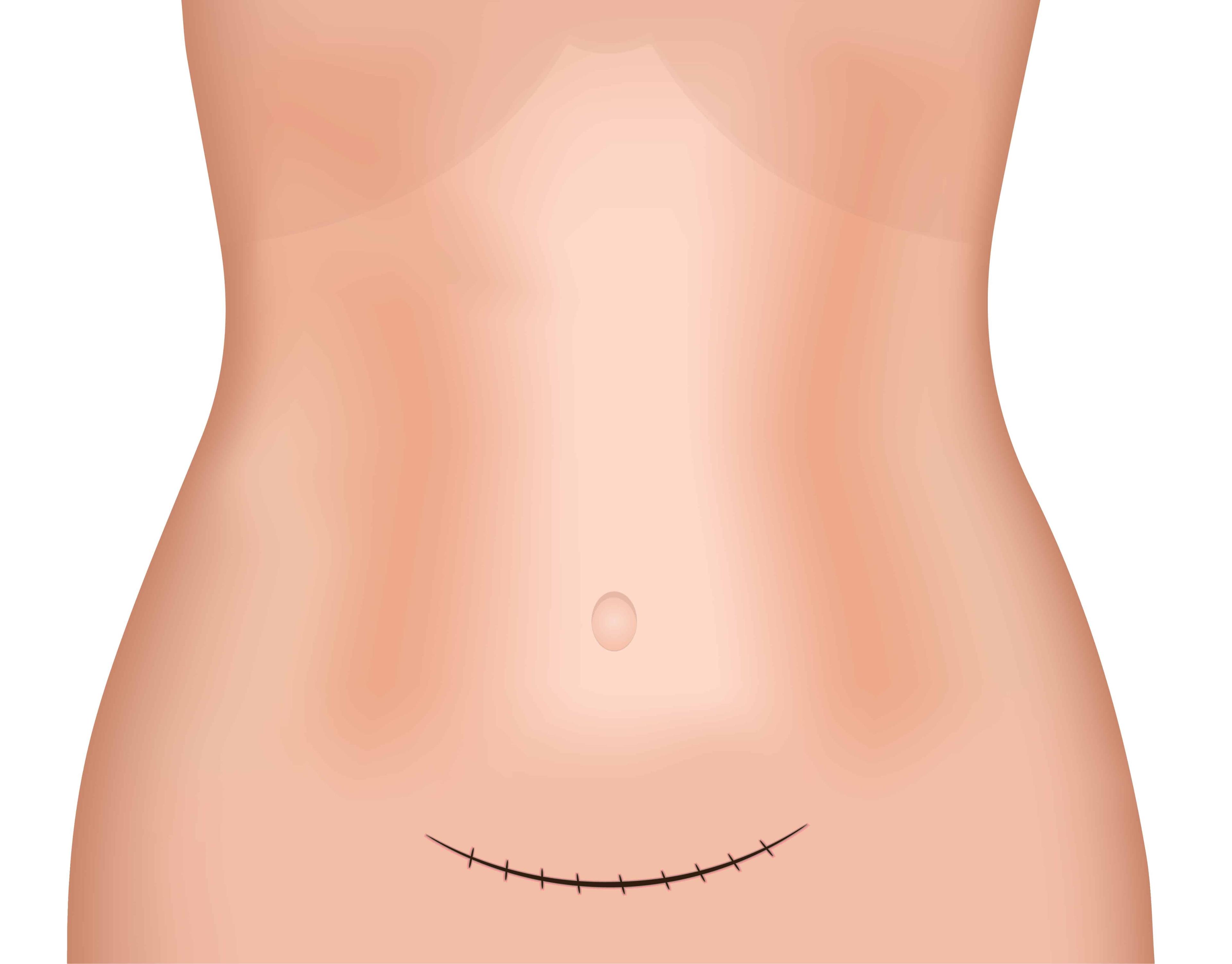 exercise-after-c-section