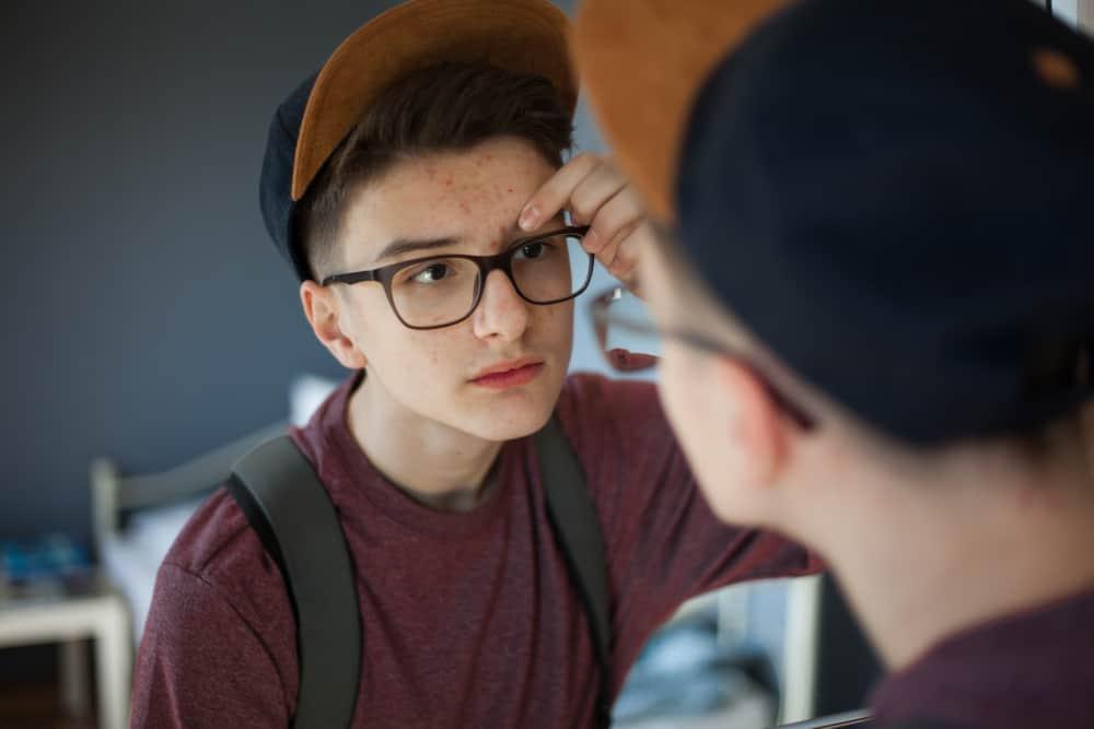 does-masturbation-cause-acne