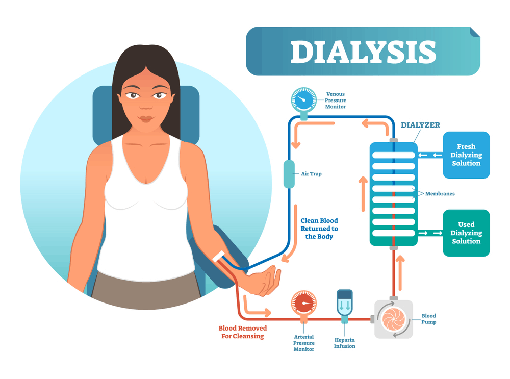 Dialysis ကျောက်ကပ်ဆေးခြင်းနဲ့ ပက်သက်ပြီး သိထားသင့်တာလေးများ။ ။