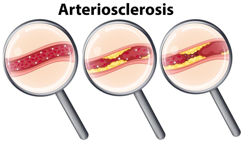 arteriosclerosis