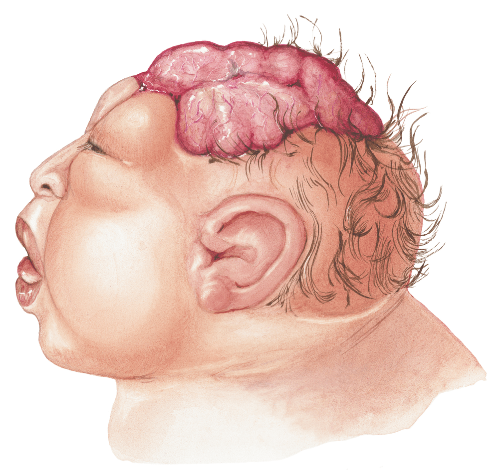 anencephaly
