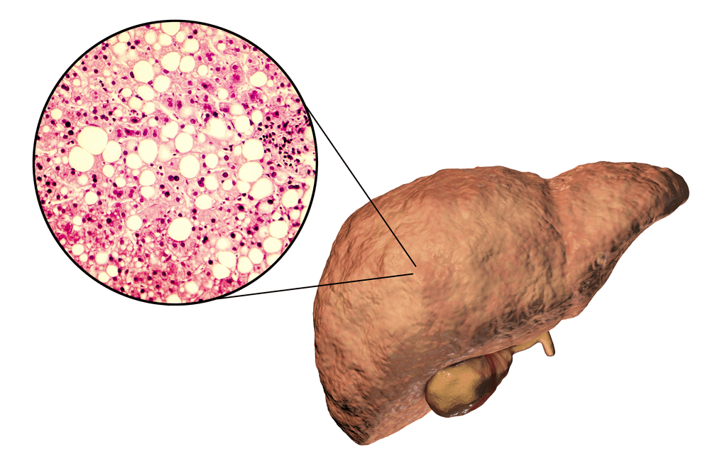 diagnosis-and-treatment-of-fatty-liver