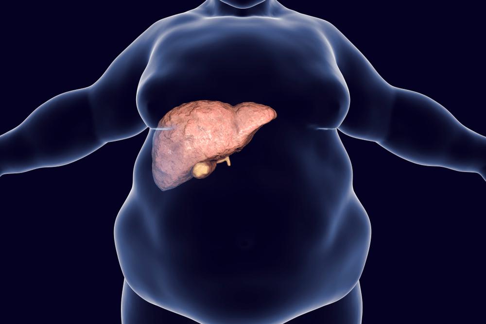 non-alcoholic-fatty-liver-disease