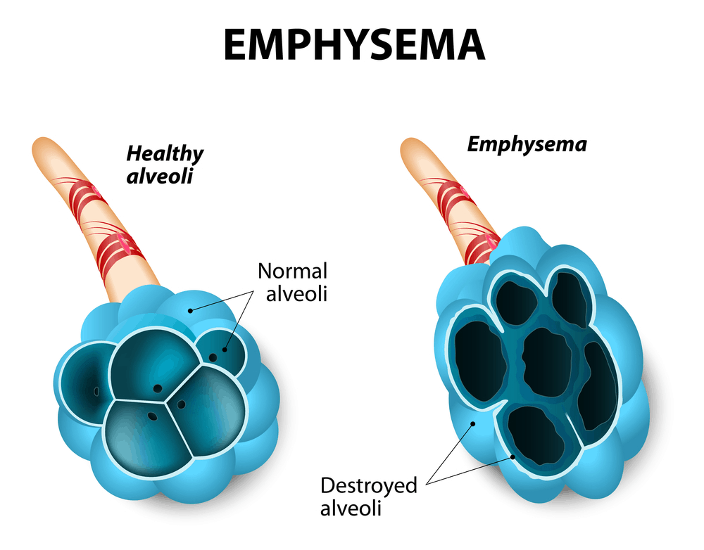 Emphysema (အဆုတ်လေအိတ်များပျက်စီးခြင်း) ဘာတွေကြောင့်ဖြစ်ရတာလဲ ။ ။