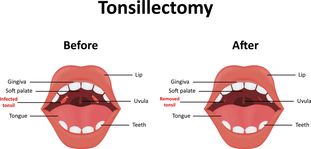 tonsilectomy