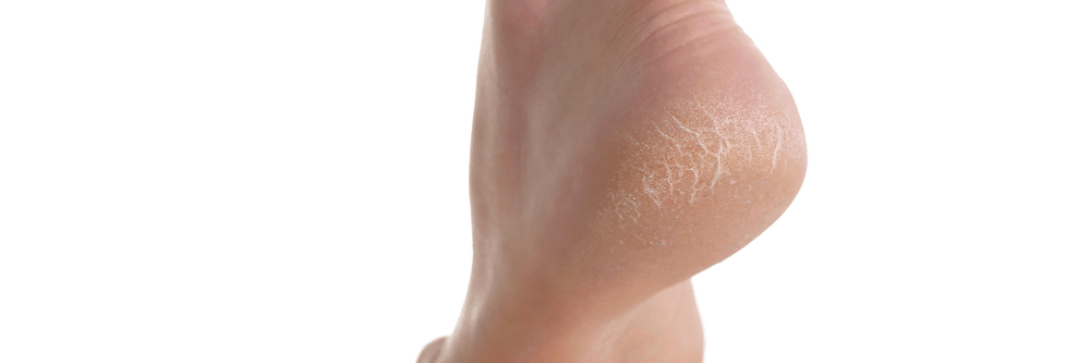 causes-of-cracked-heel