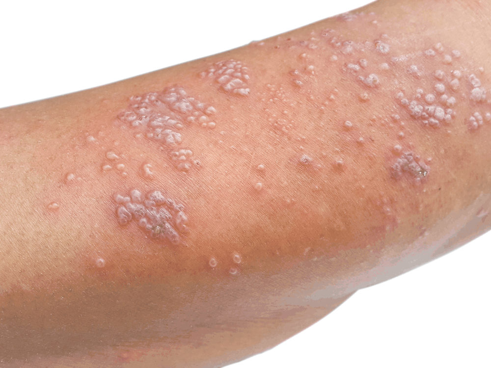 rashes-with-blisters