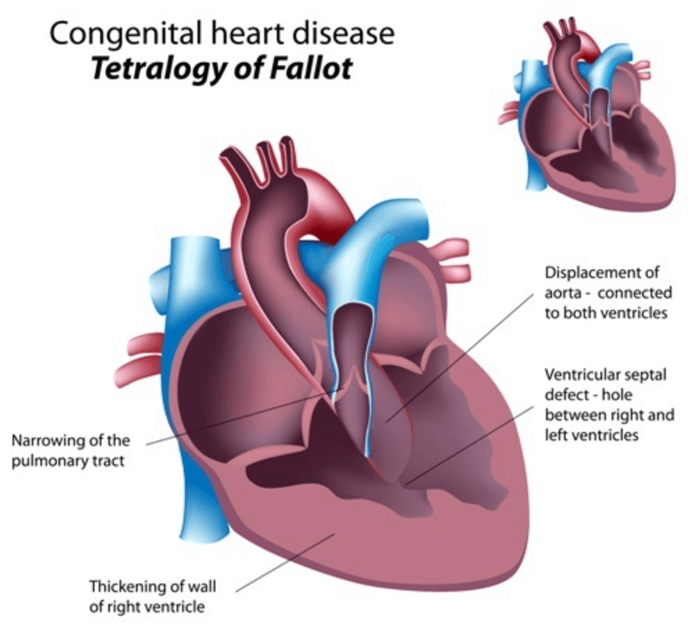 tetralogy-of-fallot