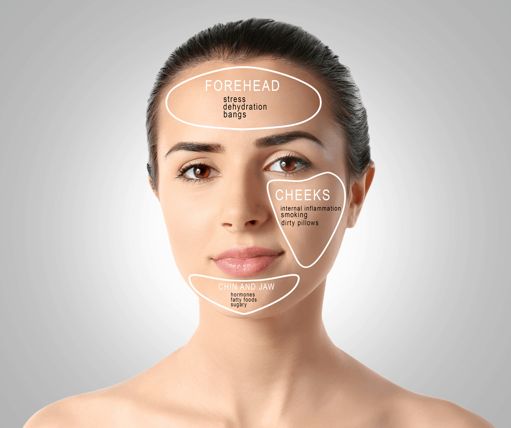 face-mapping-acnes