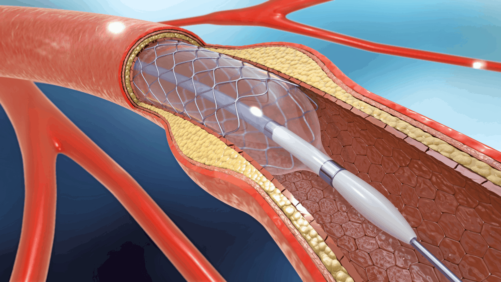stent-surgery