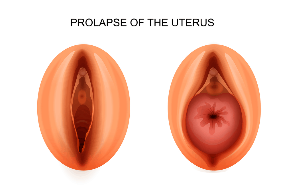 vaginal-proplase