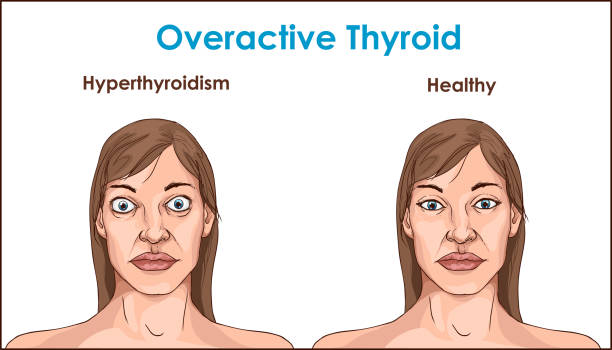 hyperthyroidism-2