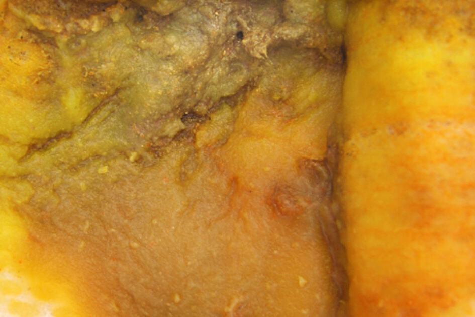 အဝါရောင်ရှိပြီး အစေ့အမှုန်ပါသော ဝမ်း