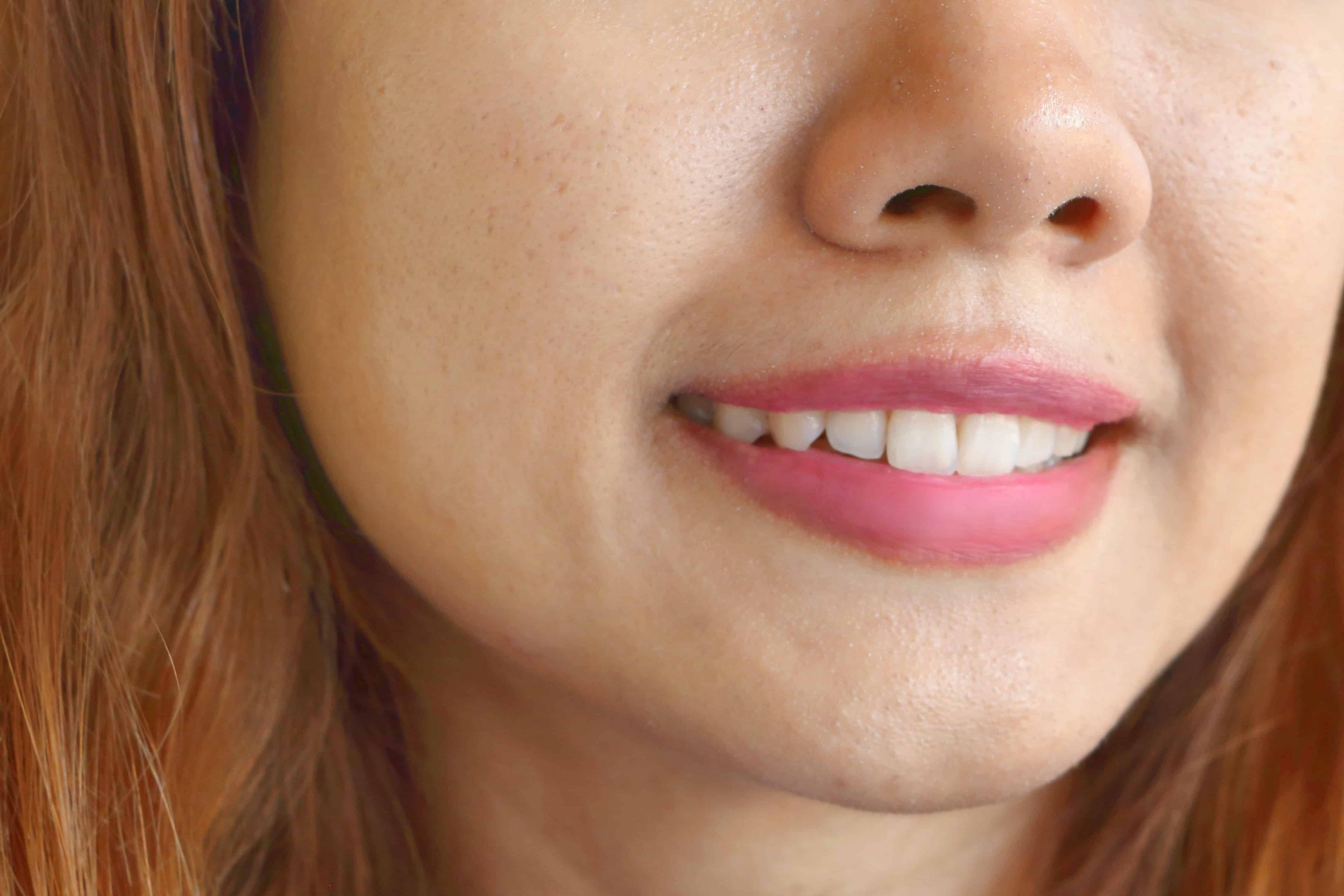 နှာခေါင်းတဝိုက် ယားယံနေတဲ့ ဆားဝက်ခြံတွေကို ၁၀ မိနစ်နဲ့ ဖယ်ရှားကြမယ်