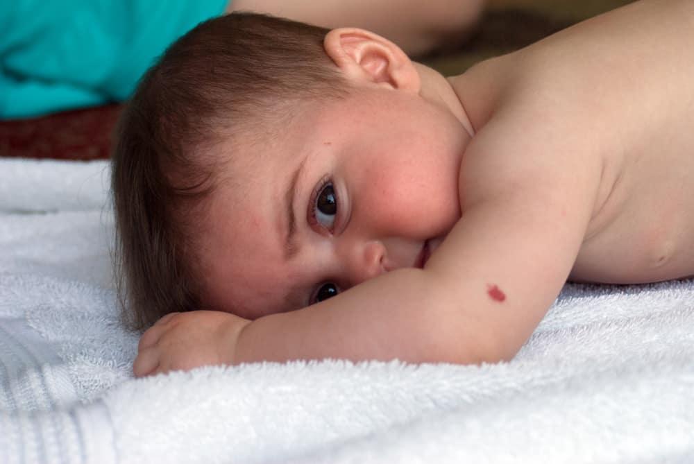 what-you-need-to-know-about-birthmarks