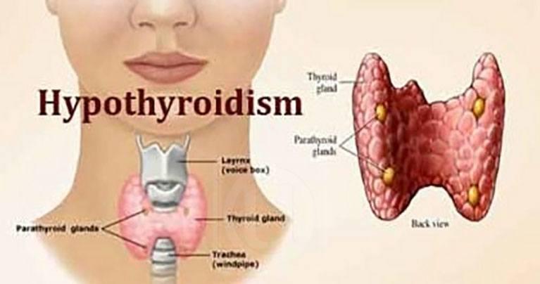hypothyroid