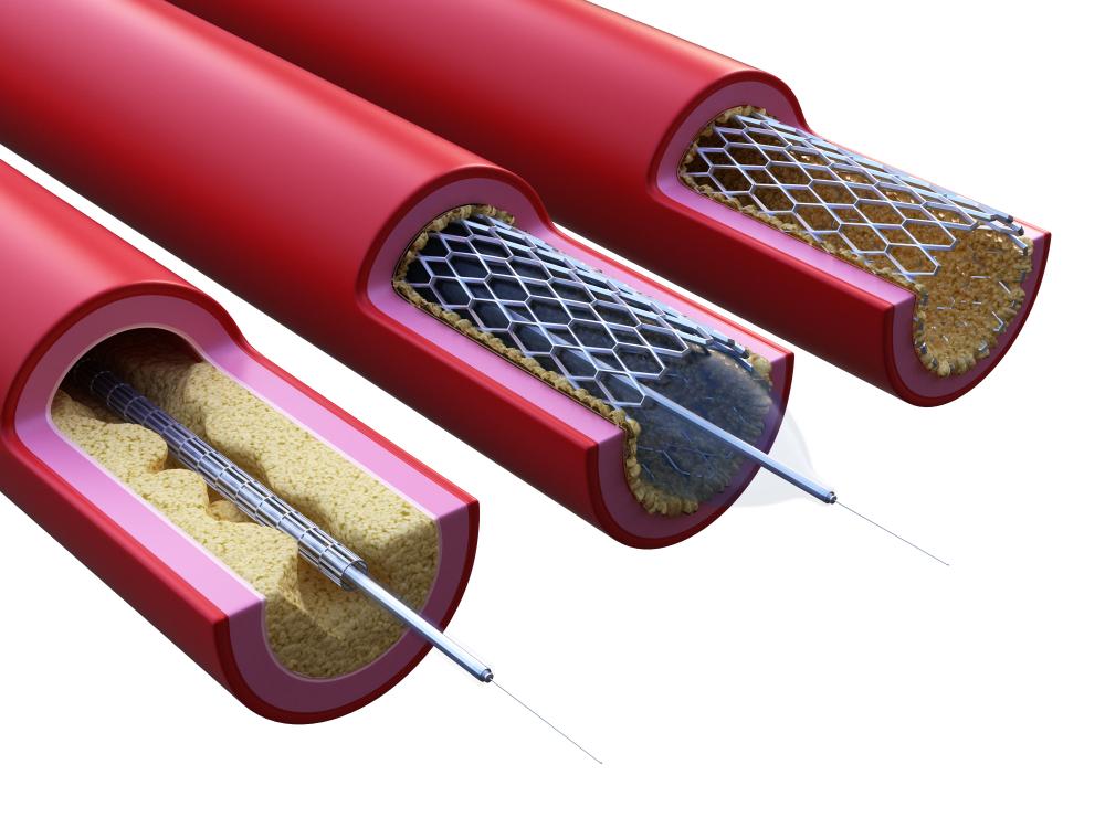 နှလုံးသွေးကြောချဲ့ခြင်း (angioplasty) ကုသမှု အကြောင်း သိကောင်းစရာများ