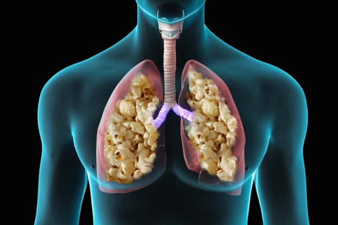 ááąáŤááşááąáŤááşááŻááş áĄááŻááş (Popcorn lung)
