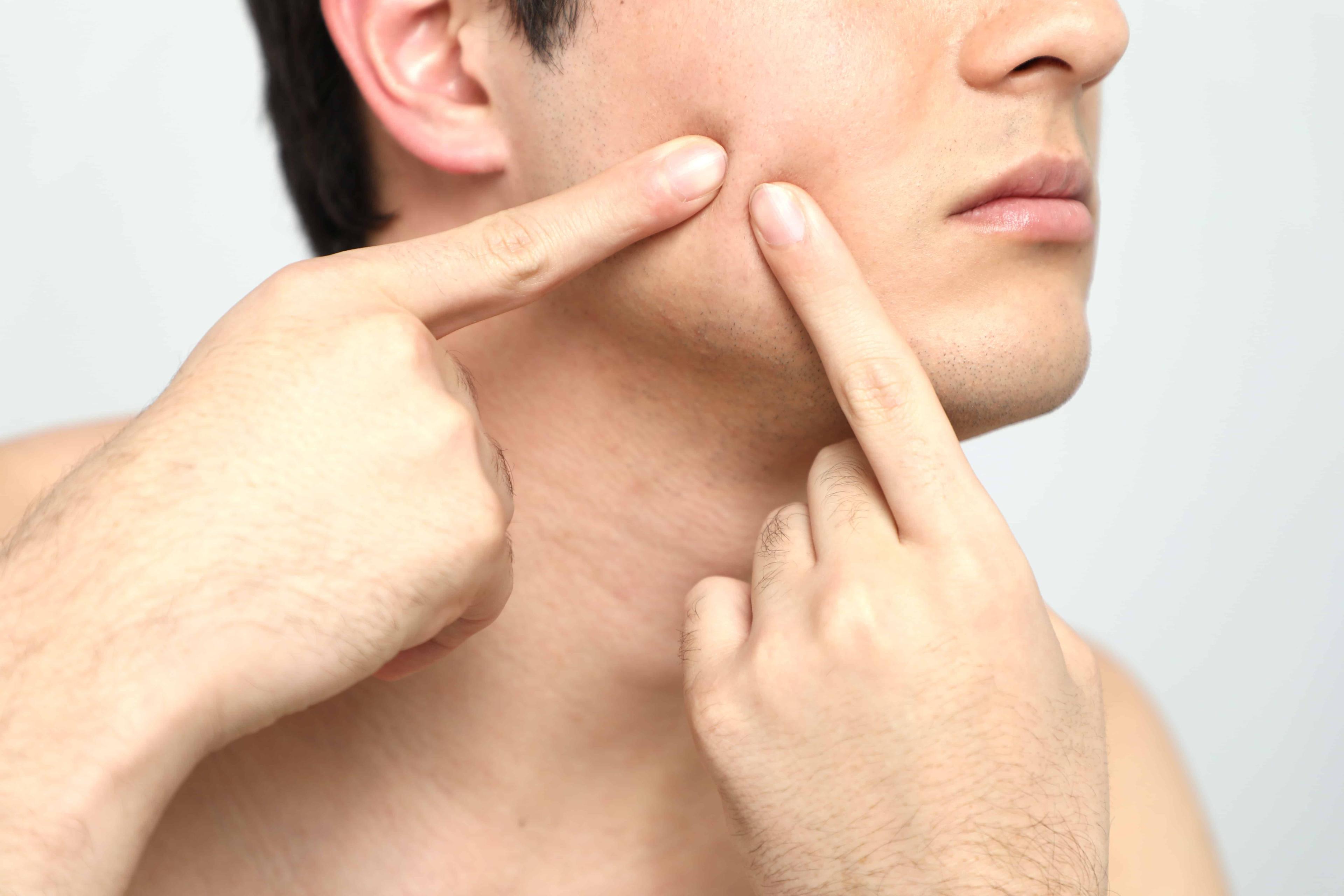 tips-to-prevent-and-reduce-acne-breakouts-in-men