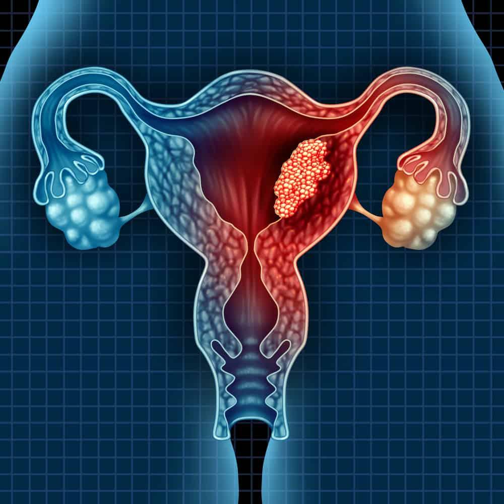 quick-brief-on-endometrial-cancer